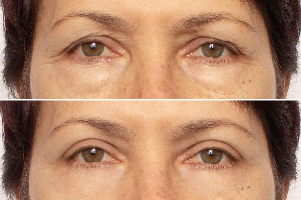 blefaroplastyka powiek